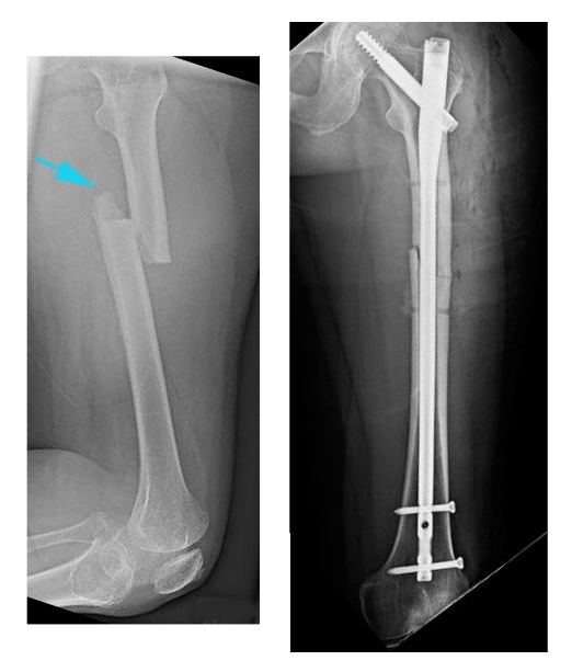 عکس رادیولوزی استخوان ران شکسته بعد از درمان