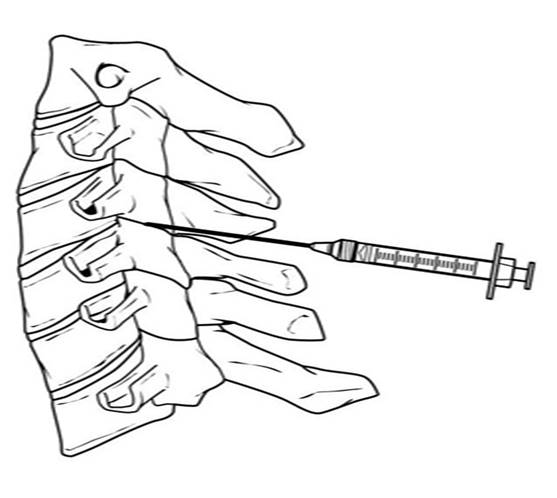 تزریق مفصل فاست در ستون فقرات گردنی