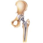 تعویض مفصل لگن