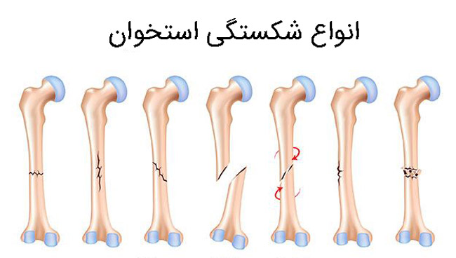 انواع شکستگی استخوان