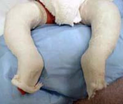 پونستی برای درمان پا چنبری