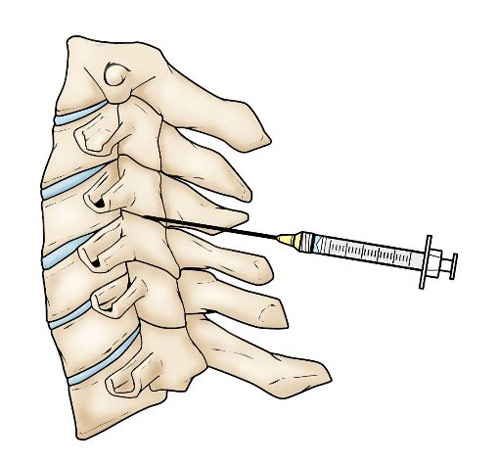  تزریق مفصل بین مهره ای پشتی در ستون فقرات گردنی