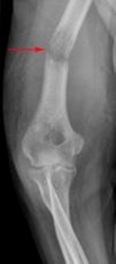 عکس رادیولوژی بیماری های متاستاتیک استخوان