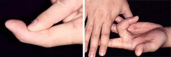 آسیب های تاندون فلکسور یا خم کننده انگشتان دست