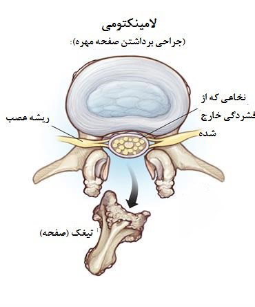 لامینکتومی (برداشتن صفحه مهره) برای درمان درد سیاتیک