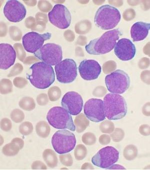 Acute lymphoblastic leukaemia (ALL)