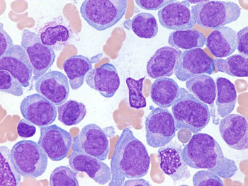 Acute myelogenous leukemia (AML)