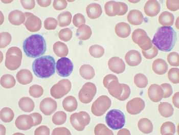 CLL (Chronic lymphocytic leukemia
