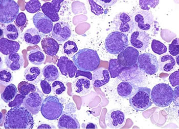 Chronic myelogenous leukemia (CML)