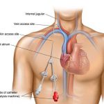 کاتتر ورید مرکزی (CVC)