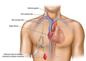 کاتتر ورید مرکزی (CVC)