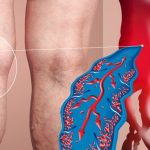 ترومبوز سیاهرگی عمقی (DVT)