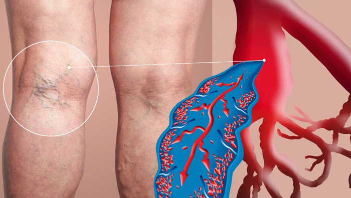 ترومبوز سیاهرگی عمقی (DVT)