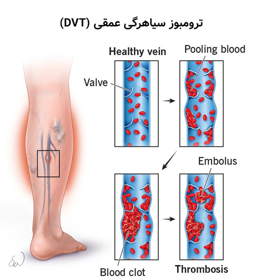 ترومبوز سیاهرگی عمقی (DVT)