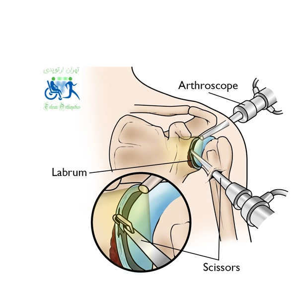  آرتروسکوپی شانه