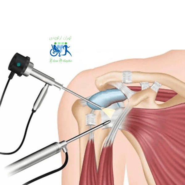 عمل آرتروسکوپی شانه 