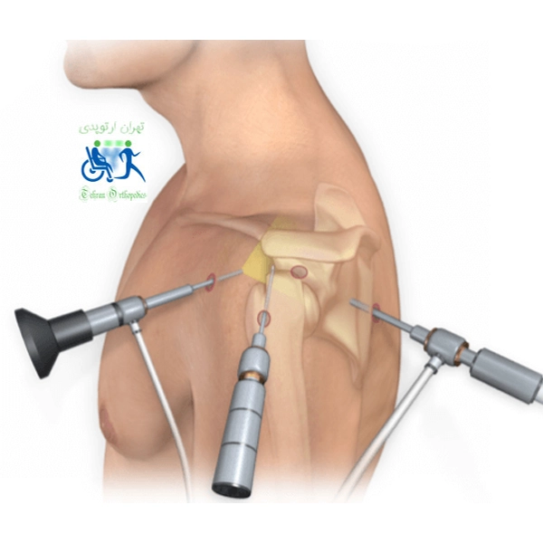 مراحل انجام آرتروسکوپی شانه