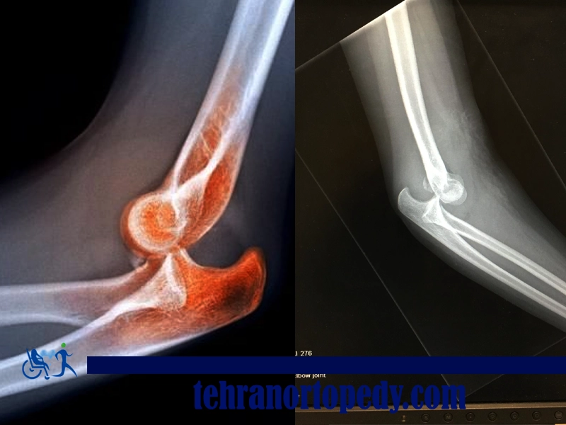 دررفتگی آرنج