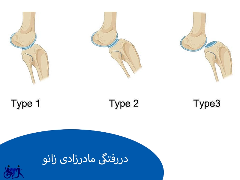 دررفتگی مادرزادی زانو