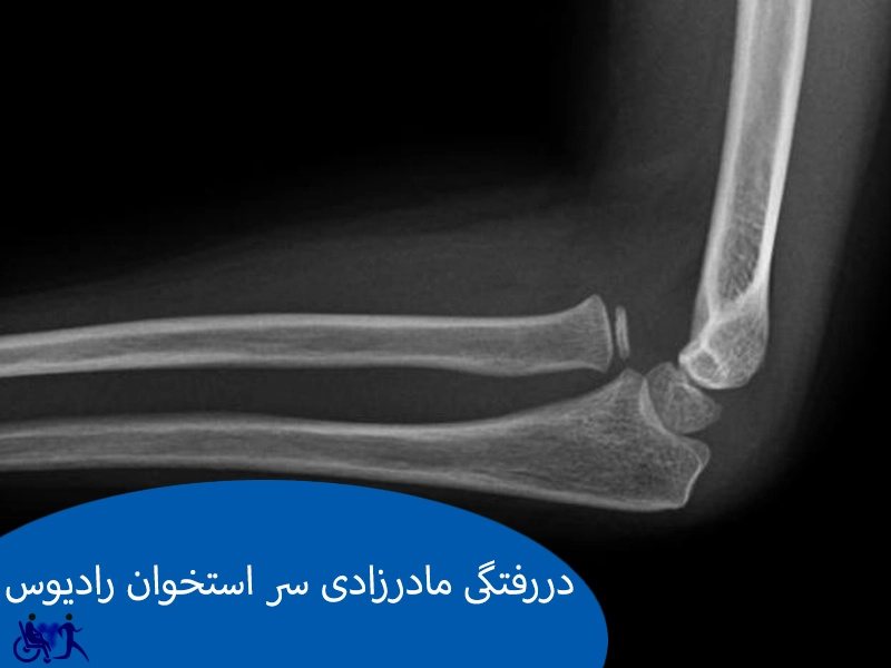 دررفتگی مادرزادی سر استخوان رادیوس