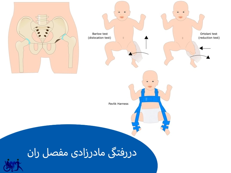 دررفتگی مادرزادی مفصل ران