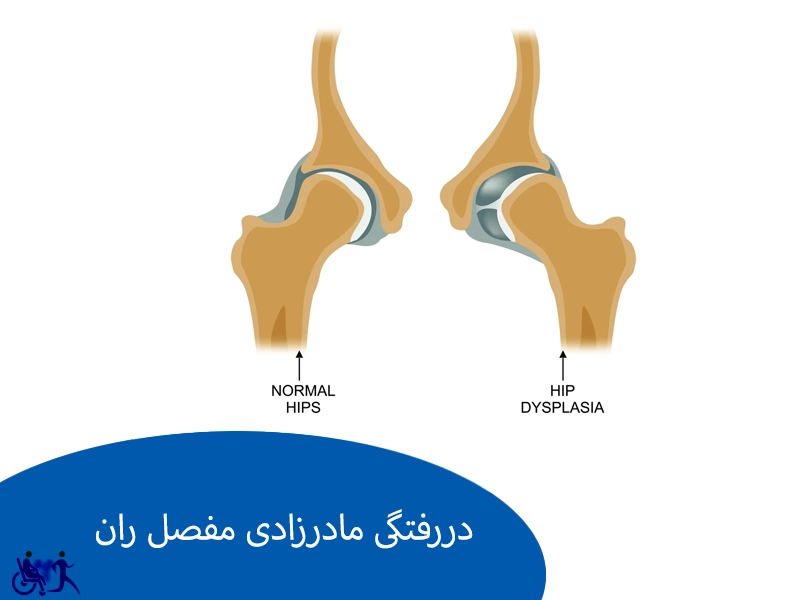 دیسپلازی مفصل ران