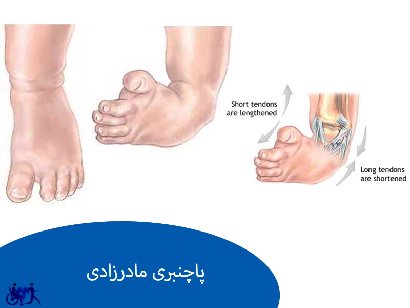 پاچنبری مادرزادی