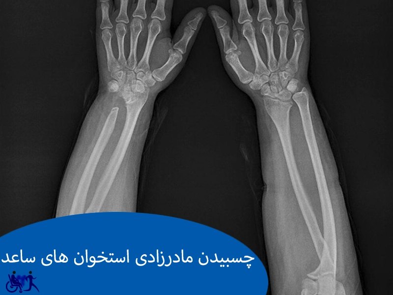 چسبیدن مادرزادی استخوان های ساعد