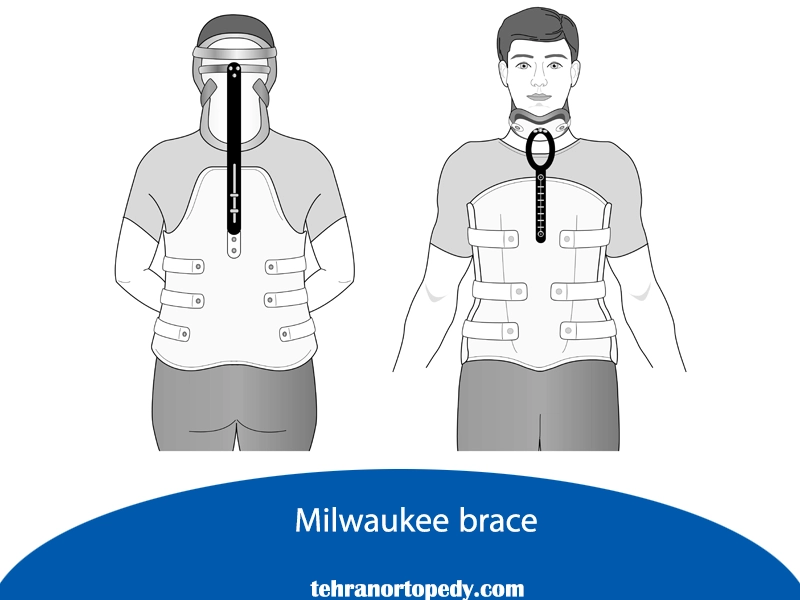 Milwaukee brace