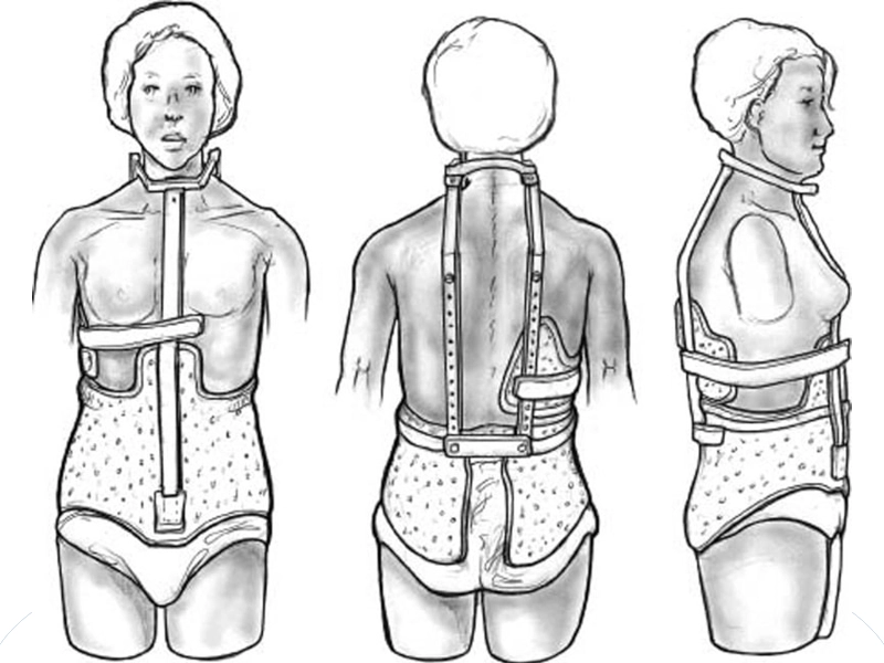 بریس میلواکی چیست