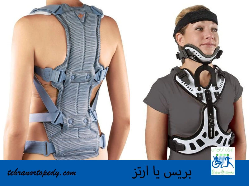 کاربرد بریس یا ارتز