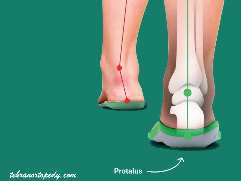 کفی‌های ارتوپدی داخل کفش